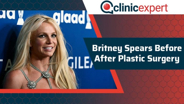 Britney Spears Before After Plastic Surgery ClinicExpert