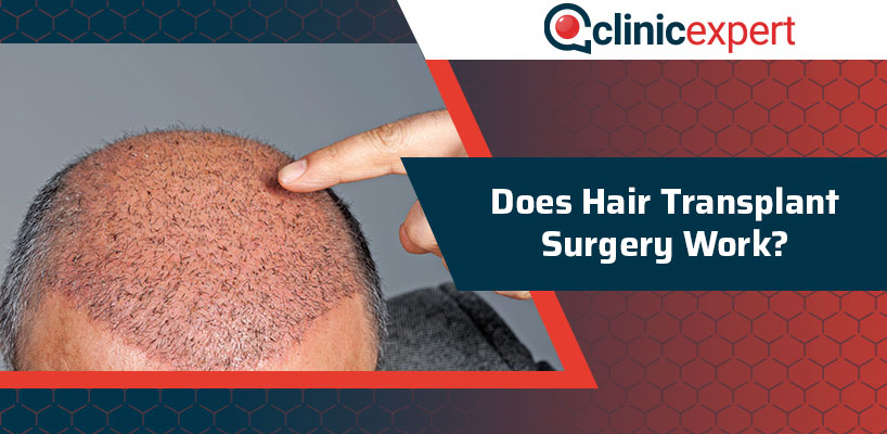 Does Hair Transplant Surgery Work Clinicexpert