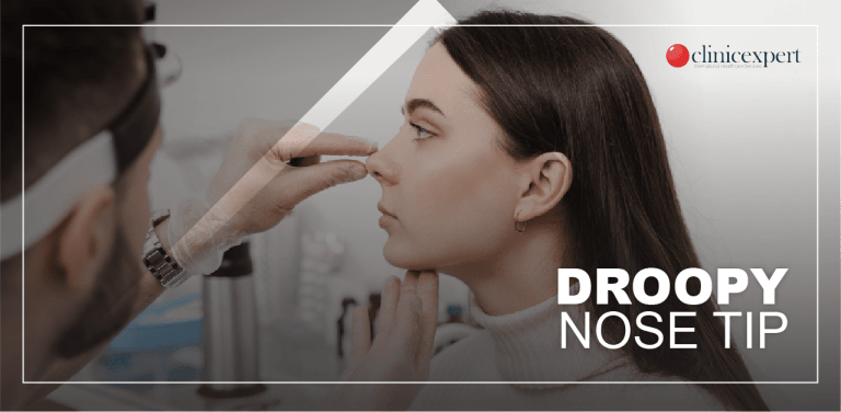 Droopy Nose Tip Clinicexpert