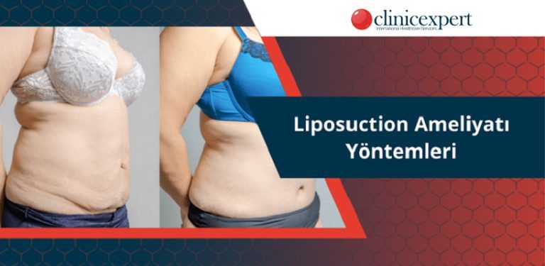 Liposuction Ameliyatı Yöntemleri Clinic Expert