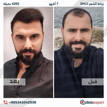 ClinicExpert Hair Transplant ClinicExpert Hair Transplant