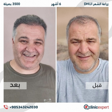 ClinicExpert Hair Transplant ClinicExpert Hair Transplant