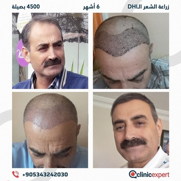 ClinicExpert Hair Transplant ClinicExpert Hair Transplant