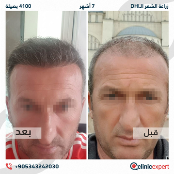 ClinicExpert Hair Transplant ClinicExpert Hair Transplant