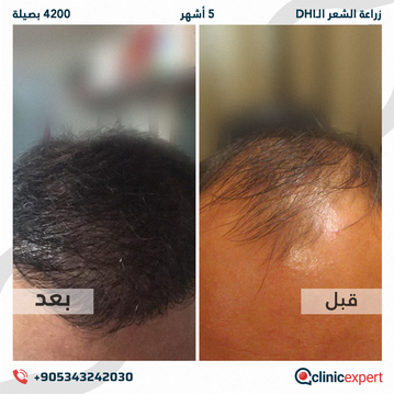 ClinicExpert Hair Transplant ClinicExpert Hair Transplant
