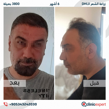 ClinicExpert Hair Transplant ClinicExpert Hair Transplant