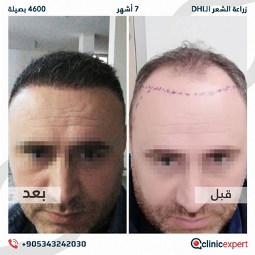 ClinicExpert Hair Transplant ClinicExpert Hair Transplant