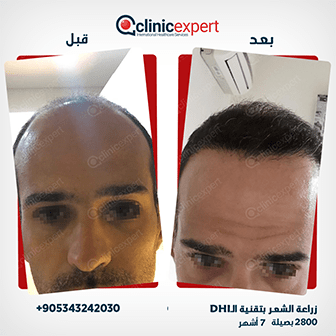 زراعة شعر الحواجب