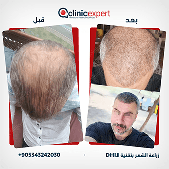 زراعة شعر الحواجب