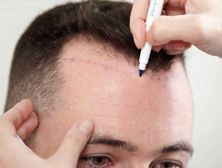 زراعة الشعر في ألمانيا