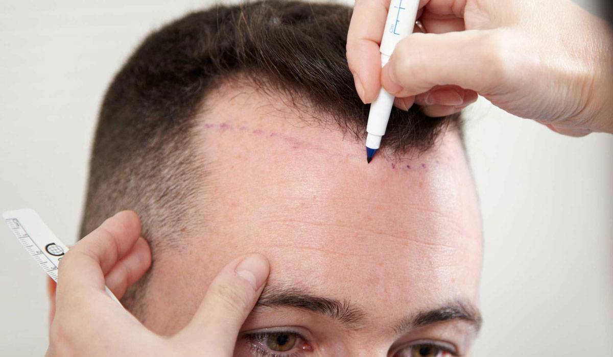 زراعة الشعر في ألمانيا