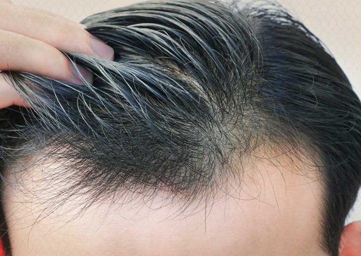 زراعة الشعر في اسطنبول