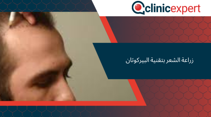 زراعة الشعر بتقنية البيركوتان