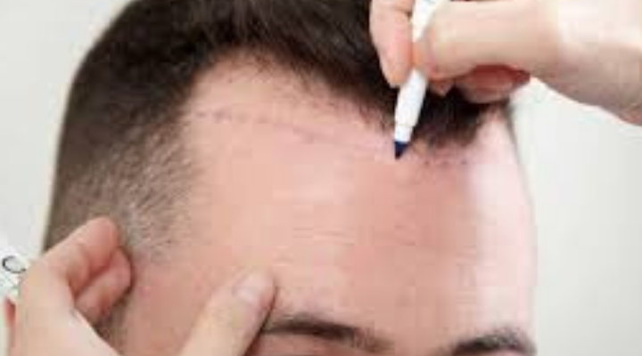 أحدث زراعة شعر