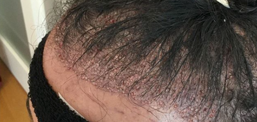 زراعة الشعر المباشرة