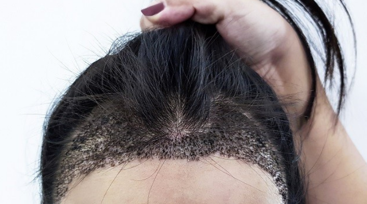 زراعة الشعر بدون حلاقة