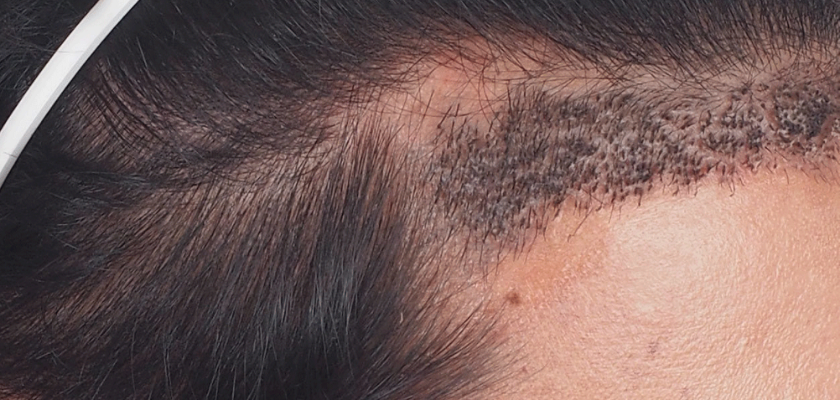 زراعة الشعر..