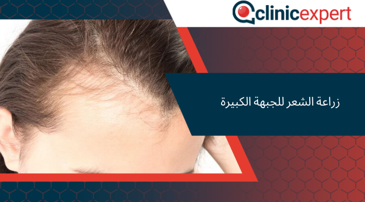 زراعة الشعر للجبهة الكبيرة