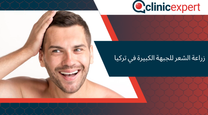 زراعة الشعر للجبهة الكبيرة في تركيا