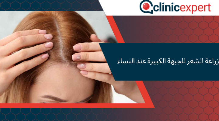 زراعة الشعر للجبهة الكبيرة عند النساء