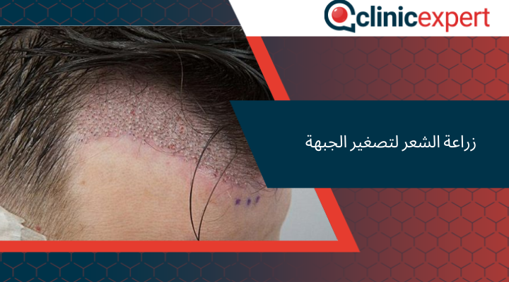 زراعة الشعر لتصغير الجبهة