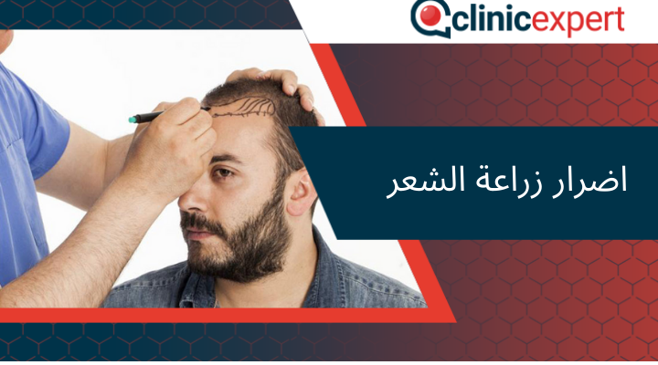 اضرار زراعة الشعر