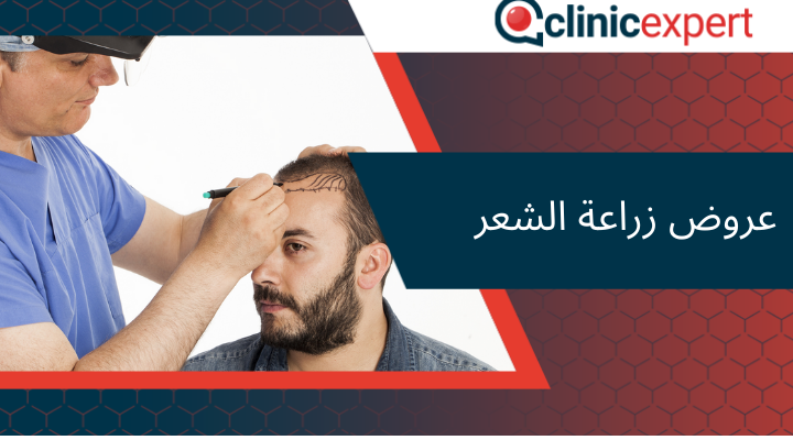 عروض زراعة الشعر