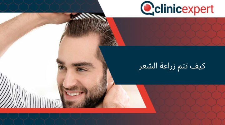 كيف تتم زراعة الشعر