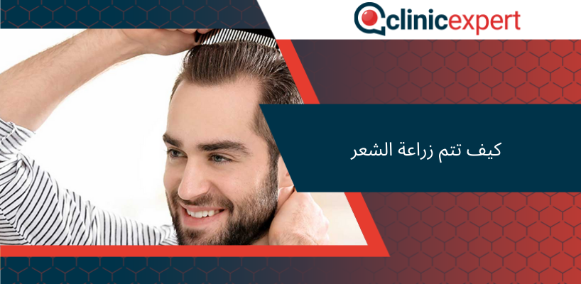 كيف تتم زراعة الشعر