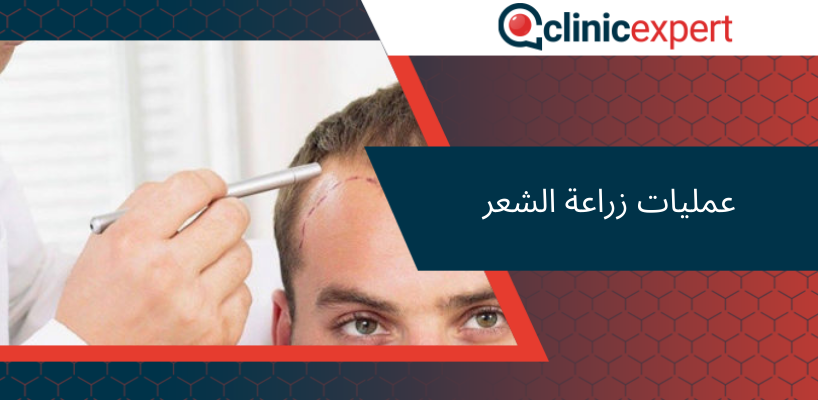 عمليات زراعة الشعر