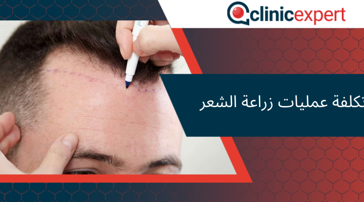  تكلفة عمليات زراعة الشعر