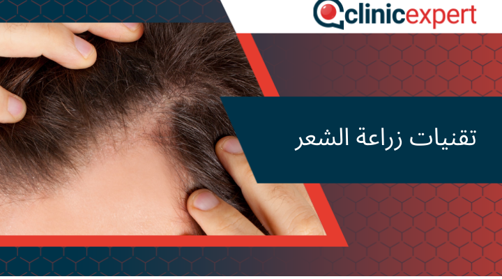 تقنيات زراعة الشعر