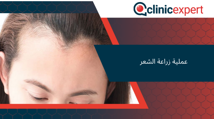 عملية زراعة الشعر