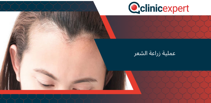 عملية زراعة الشعر