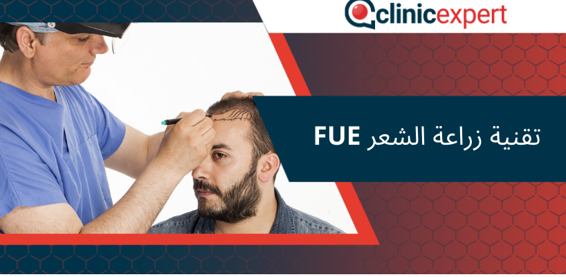 تقنية زراعة الشعر FUE