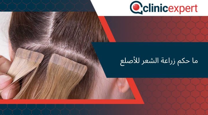 ما حكم زراعة الشعر للأصلع