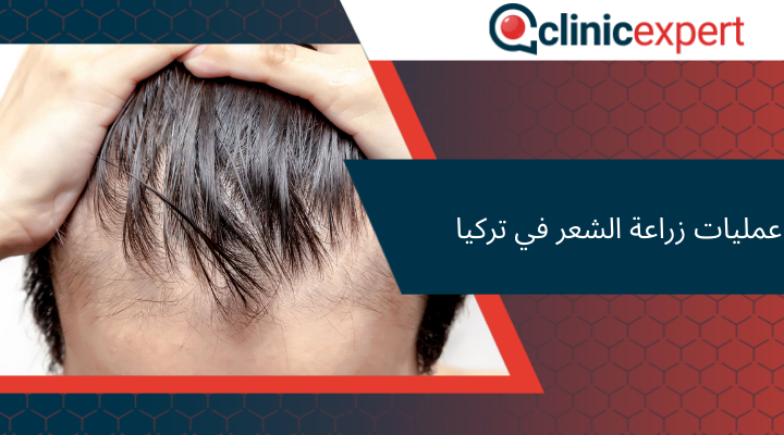 عمليات زراعة الشعر في تركيا