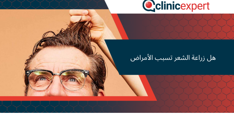 هل زراعة الشعر تسبب الأمراض!