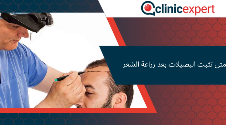 متى تثبت البصيلات بعد زراعة الشعر