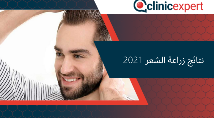 نتائج زراعة الشعر 2021