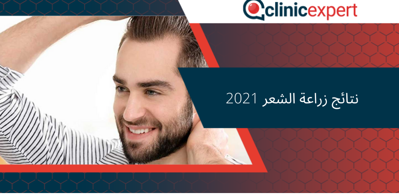 نتائج زراعة الشعر 2021