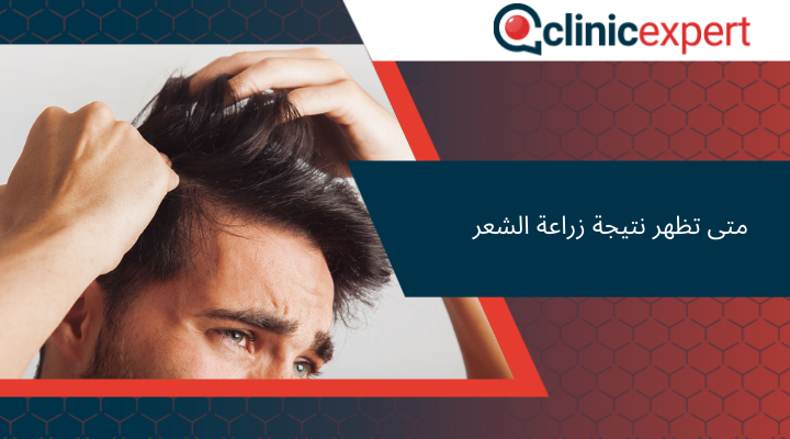 متى تظهر نتيجة زراعة الشعر