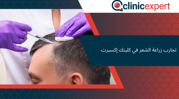 تجارب زراعة الشعر