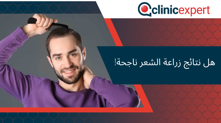 هل نتائج زراعة الشعر ناجحة