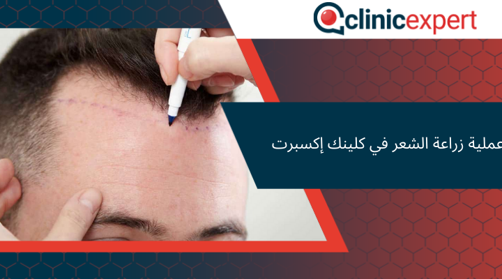 عملية زراعة الشعر في كلينك إكسبرت