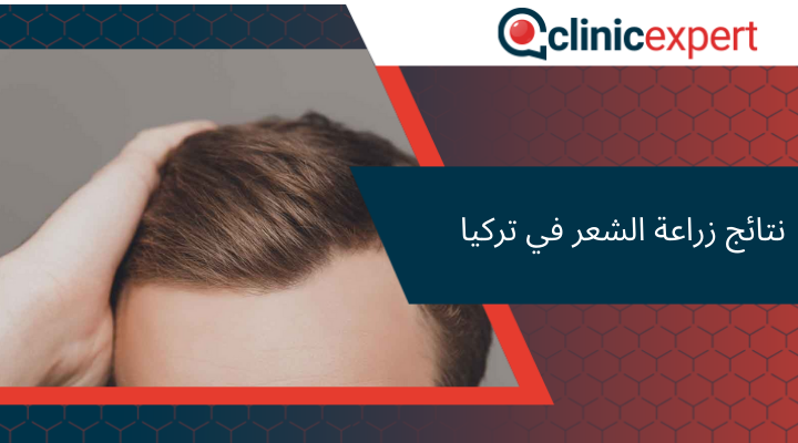  نتائج زراعة الشعر في تركيا