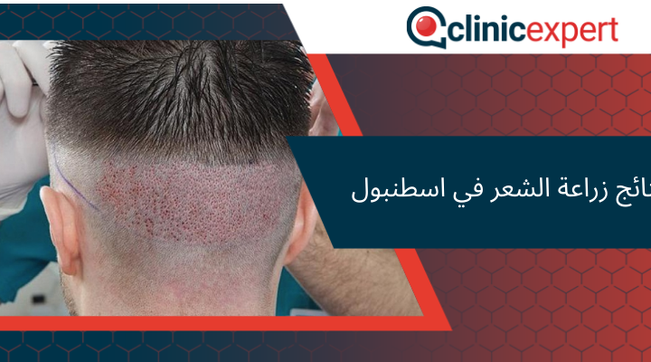  نتائج زراعة الشعر في اسطنبول