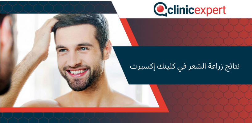  نتائج زراعة الشعر في كلينك إكسبرت