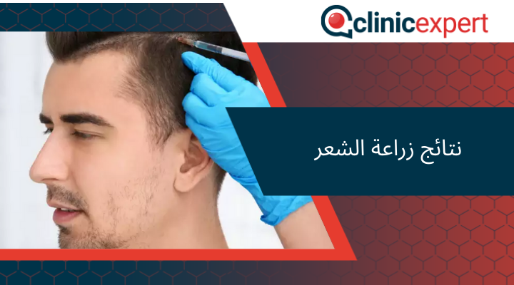 نتائج زراعة الشعر