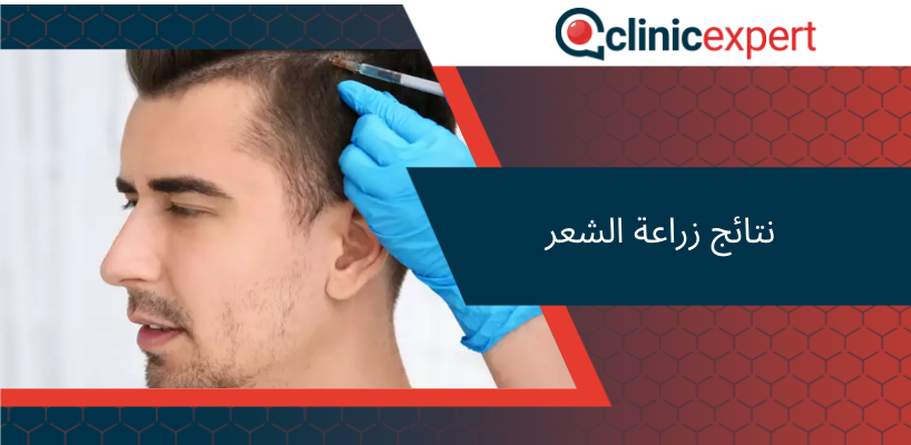 نتائج زراعة الشعر